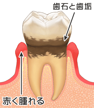 歯周病03