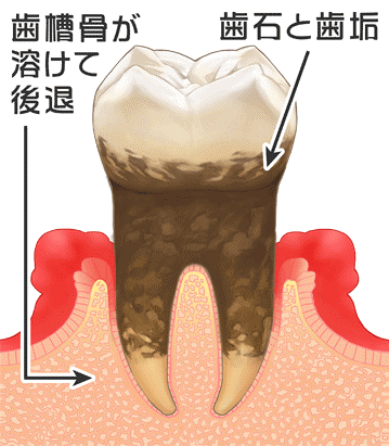 歯周病04
